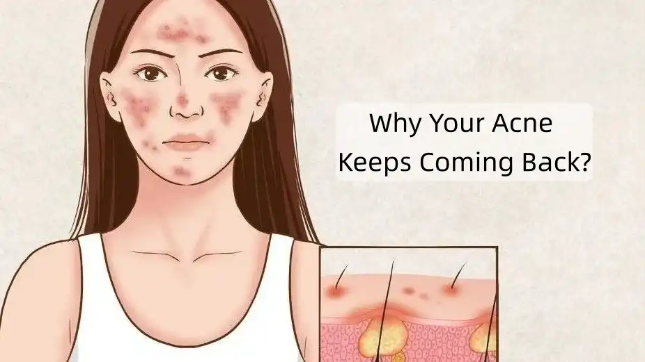 Why Your Acne Keeps Coming Back?